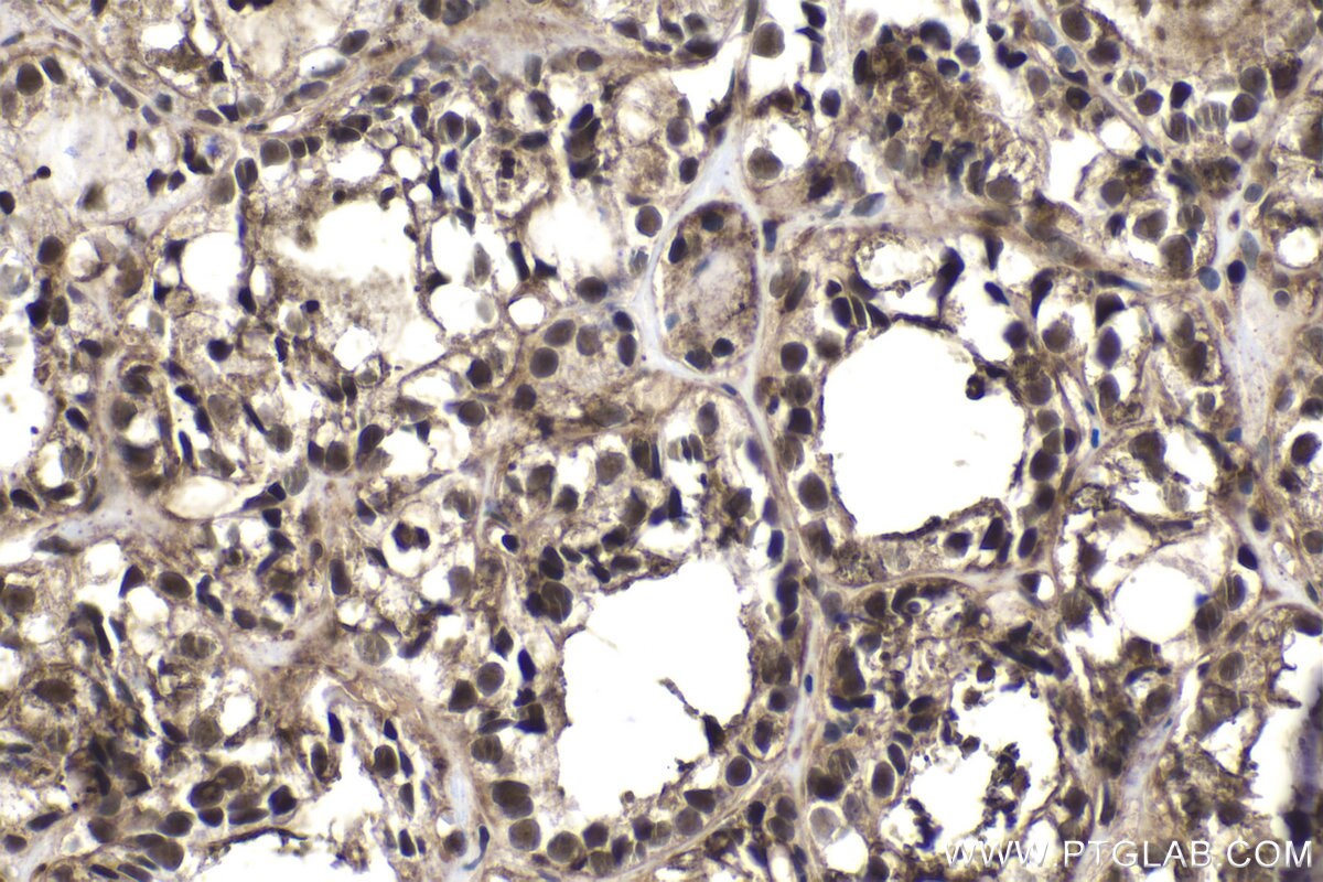 Immunohistochemical analysis of paraffin-embedded human thyroid cancer tissue slide using KHC1564 (PSMA4 IHC Kit).