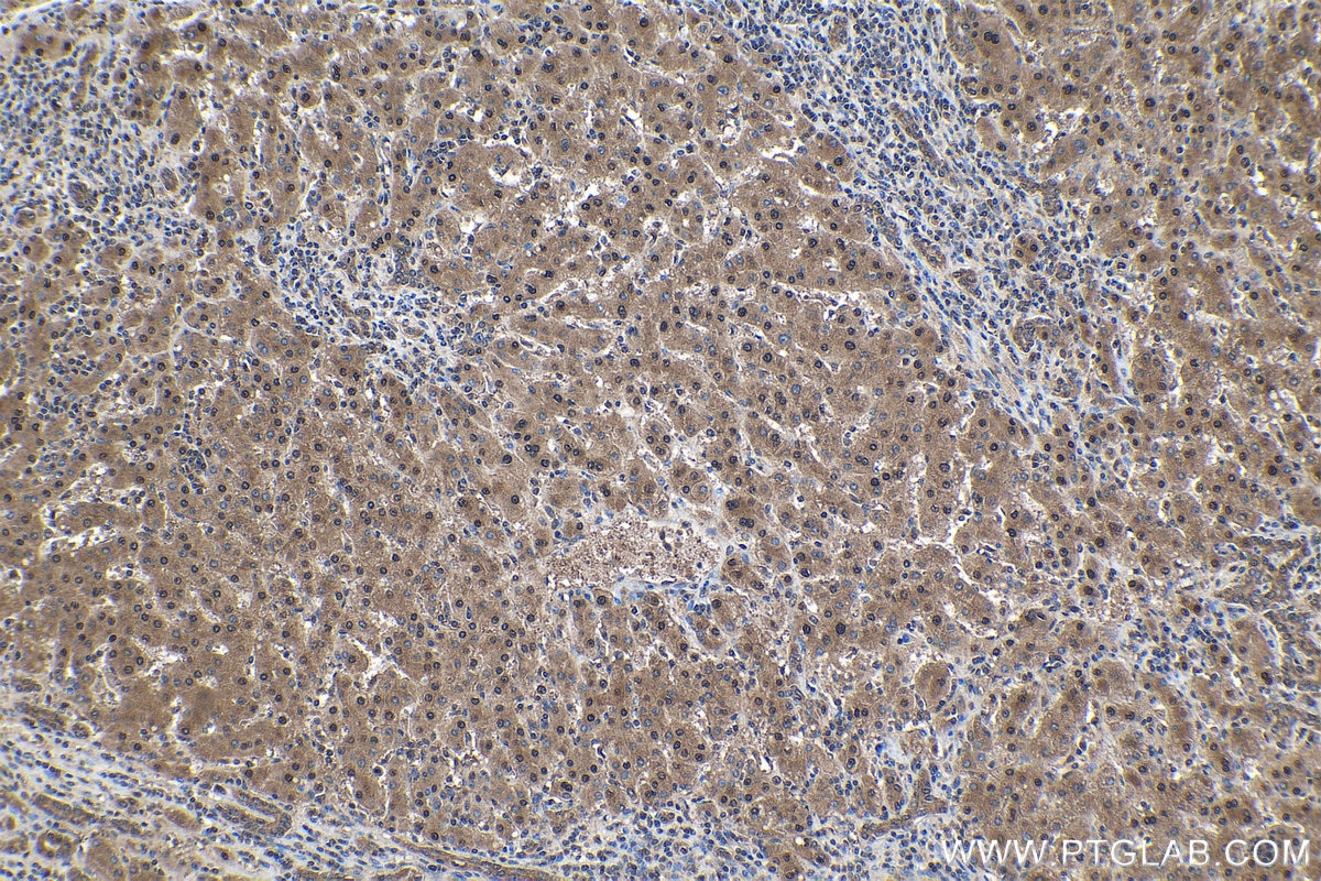 Immunohistochemical analysis of paraffin-embedded human liver cancer tissue slide using KHC1571 (PSMA5 IHC Kit).