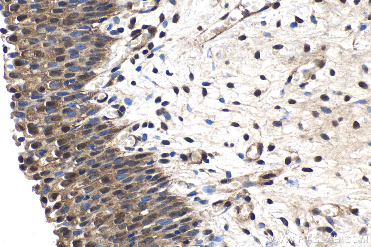 Immunohistochemical analysis of paraffin-embedded human urothelial carcinoma tissue slide using KHC1571 (PSMA5 IHC Kit).