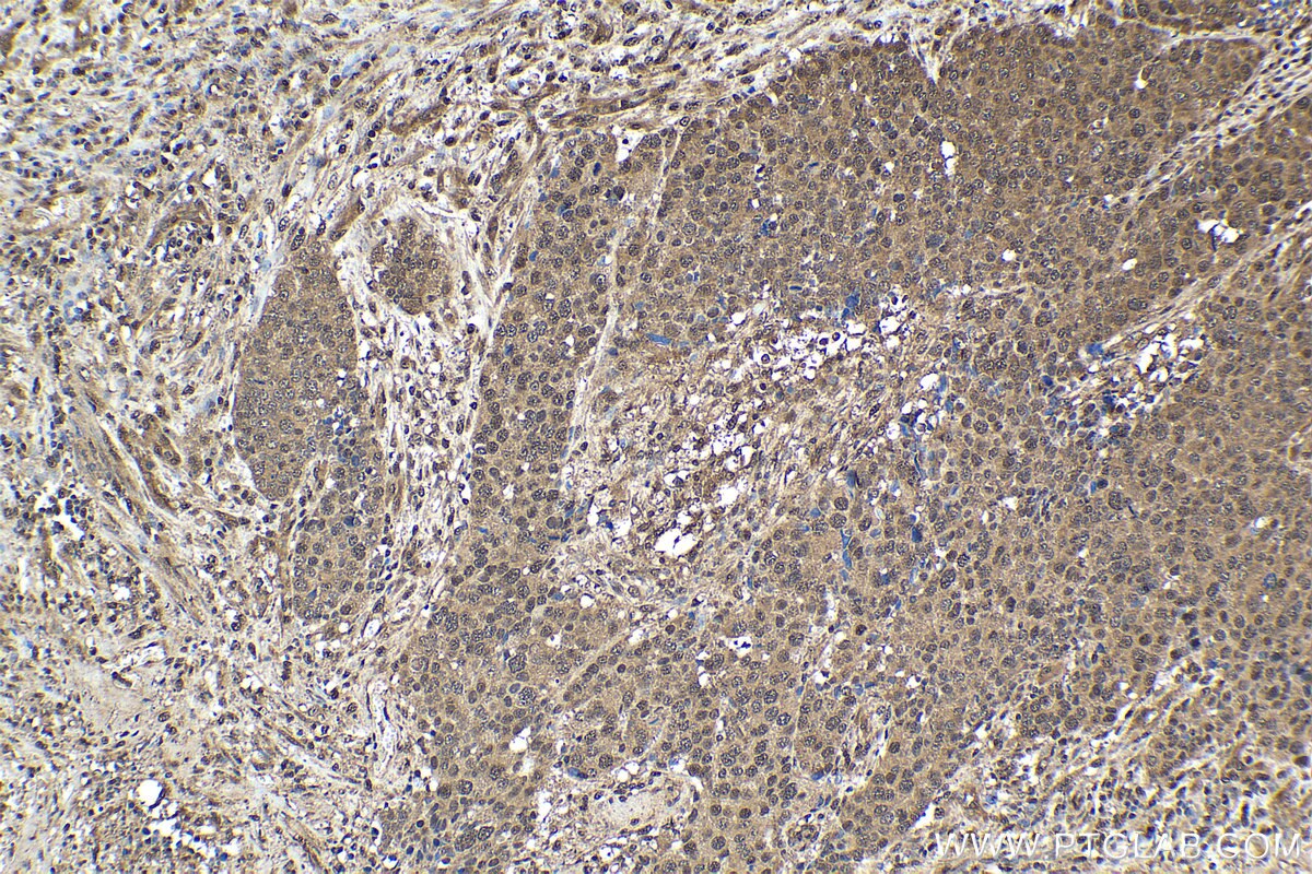 Immunohistochemical analysis of paraffin-embedded human stomach cancer tissue slide using KHC1638 (PSMA6 IHC Kit).