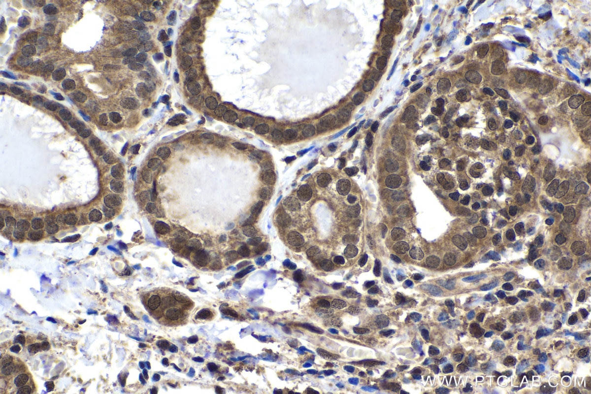 Immunohistochemical analysis of paraffin-embedded human thyroid cancer tissue slide using KHC1638 (PSMA6 IHC Kit).
