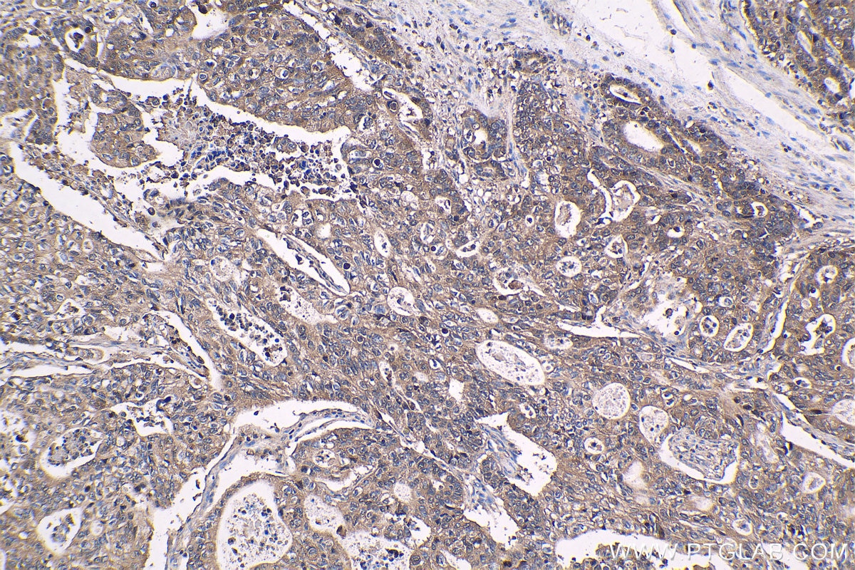 Immunohistochemical analysis of paraffin-embedded human stomach cancer tissue slide using KHC1429 (PSMA7 IHC Kit).