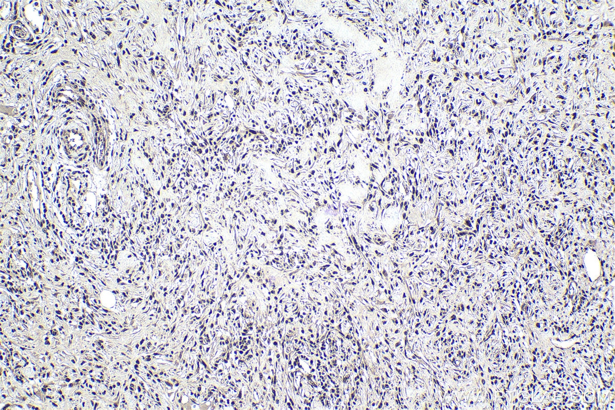 Immunohistochemical analysis of paraffin-embedded human colon cancer tissue slide using KHC0983 (PSMA8 IHC Kit).