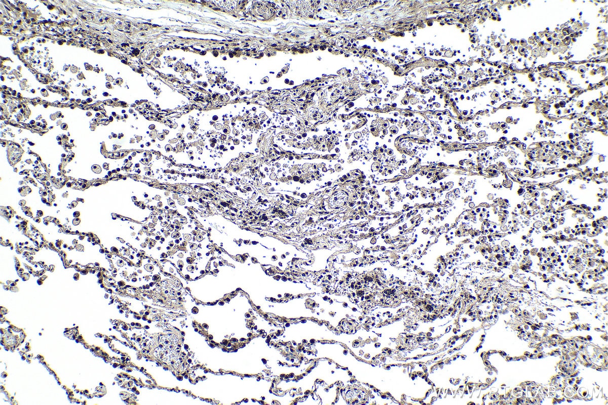 Immunohistochemical analysis of paraffin-embedded human lung cancer (ANCT) tissue slide using KHC0983 (PSMA8 IHC Kit).
