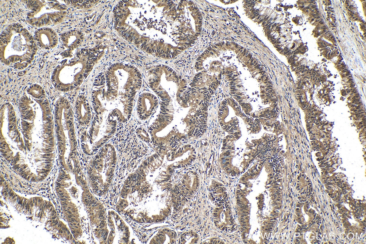 Immunohistochemical analysis of paraffin-embedded human pancreas cancer tissue slide using KHC1550 (PSMB1 IHC Kit).