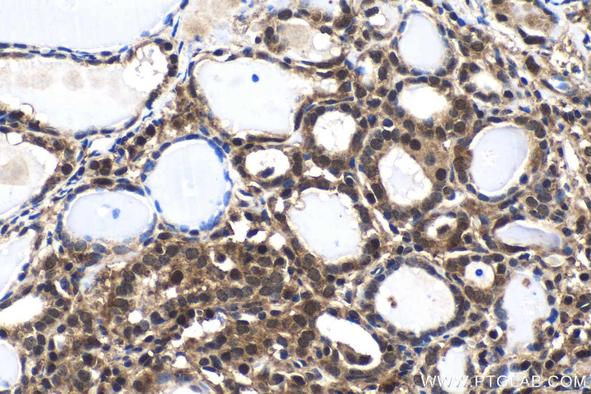 Immunohistochemical analysis of paraffin-embedded human thyroid cancer tissue slide using KHC1550 (PSMB1 IHC Kit).