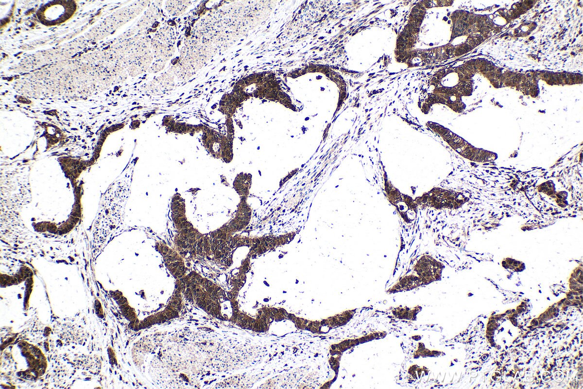 Immunohistochemical analysis of paraffin-embedded human urothelial carcinoma tissue slide using KHC1591 (PSMB10 IHC Kit).