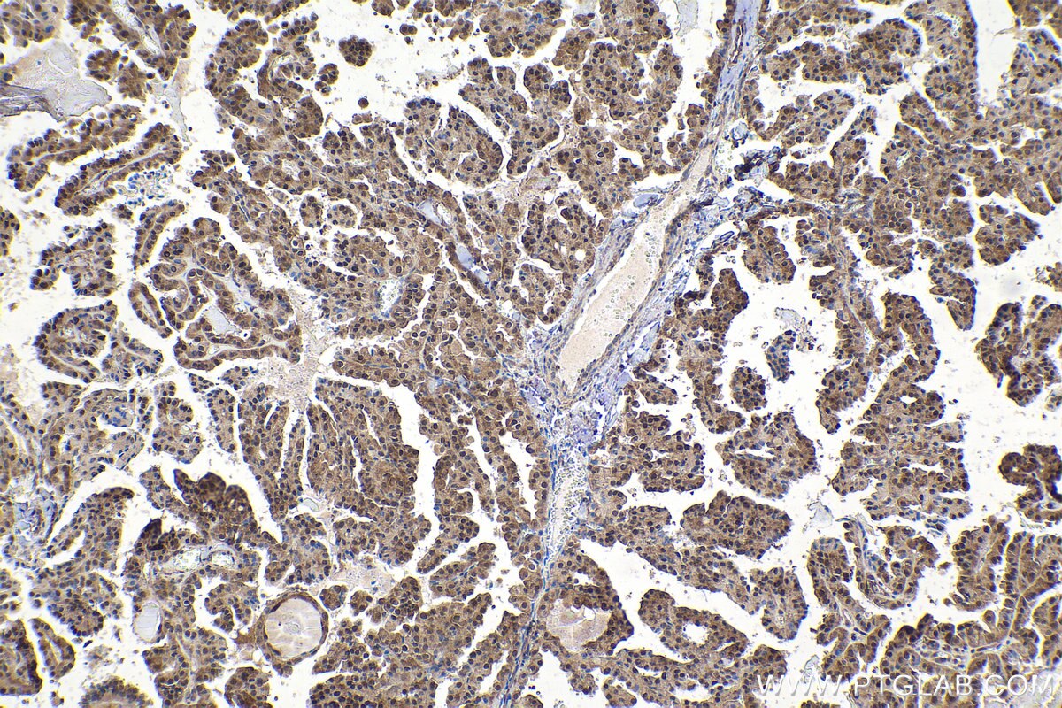 Immunohistochemical analysis of paraffin-embedded human thyroid cancer tissue slide using KHC1615 (PSMB2 IHC Kit).