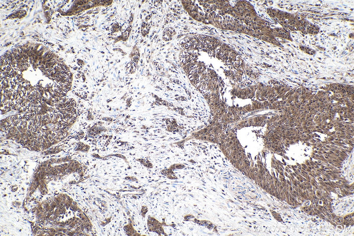 Immunohistochemical analysis of paraffin-embedded human urothelial carcinoma tissue slide using KHC1615 (PSMB2 IHC Kit).