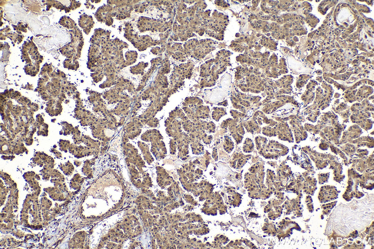 Immunohistochemical analysis of paraffin-embedded human thyroid cancer tissue slide using KHC1614 (PSMB3 IHC Kit).
