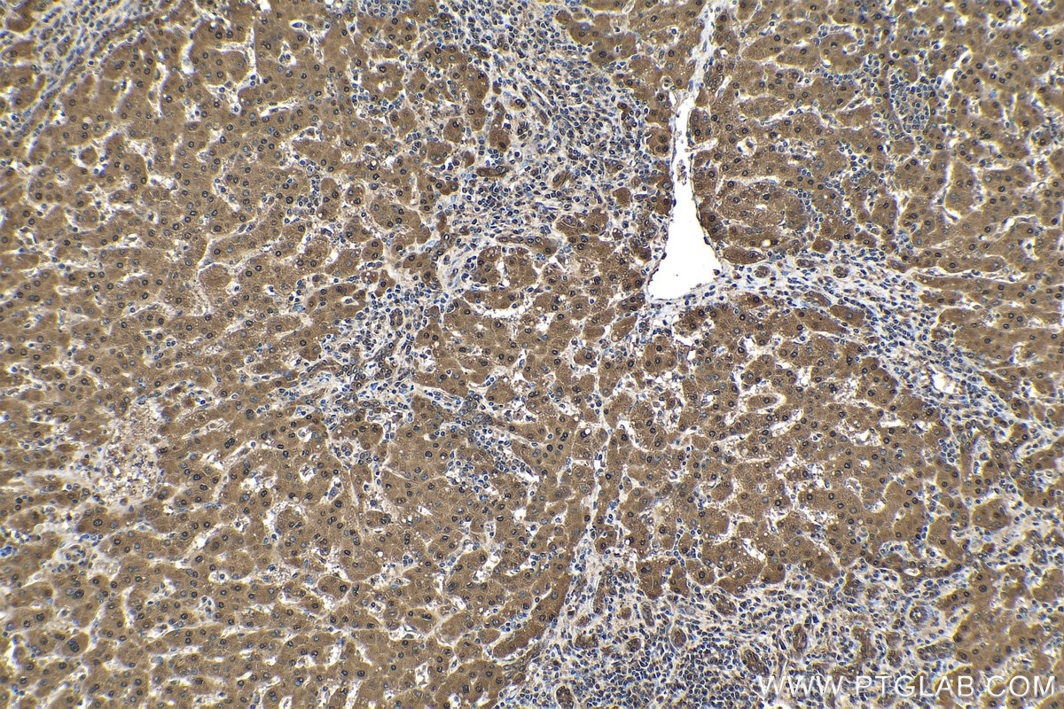 Immunohistochemical analysis of paraffin-embedded human liver cancer tissue slide using KHC1572 (PSMB4 IHC Kit).