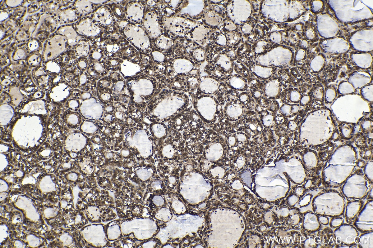 Immunohistochemical analysis of paraffin-embedded human thyroid cancer tissue slide using KHC1572 (PSMB4 IHC Kit).