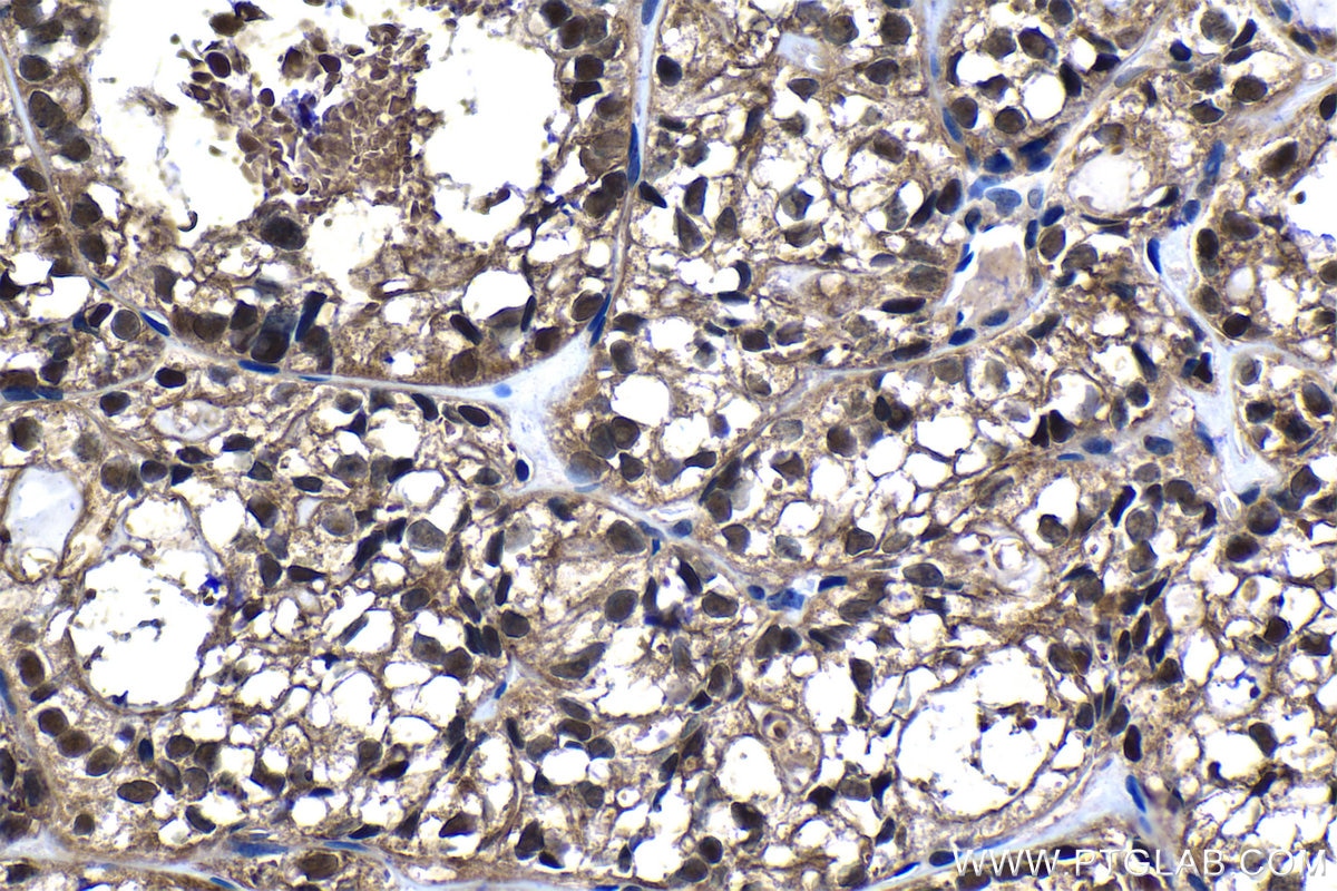 Immunohistochemical analysis of paraffin-embedded human thyroid cancer tissue slide using KHC1308 (PSMB5 IHC Kit).