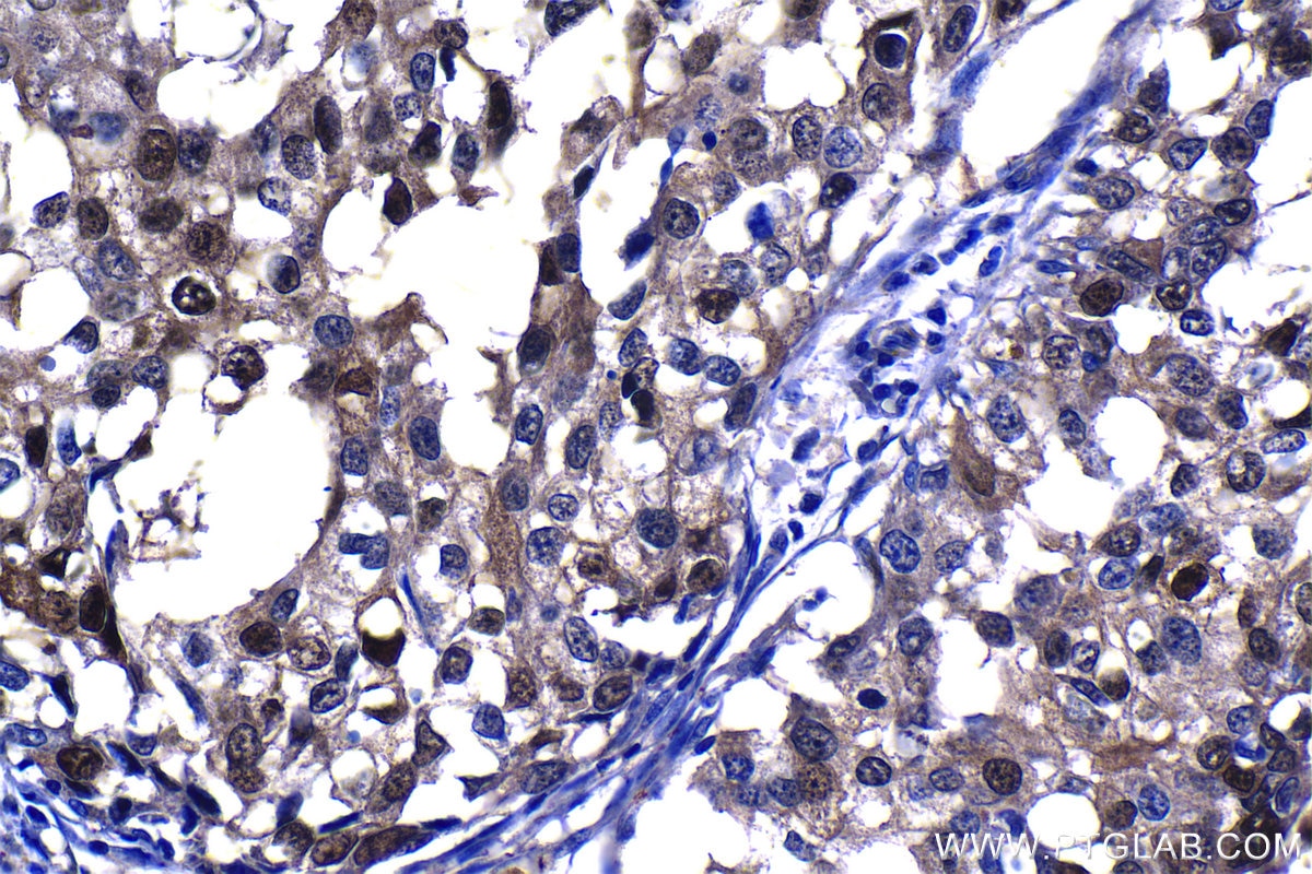 Immunohistochemical analysis of paraffin-embedded human breast cancer tissue slide using KHC1308 (PSMB5 IHC Kit).