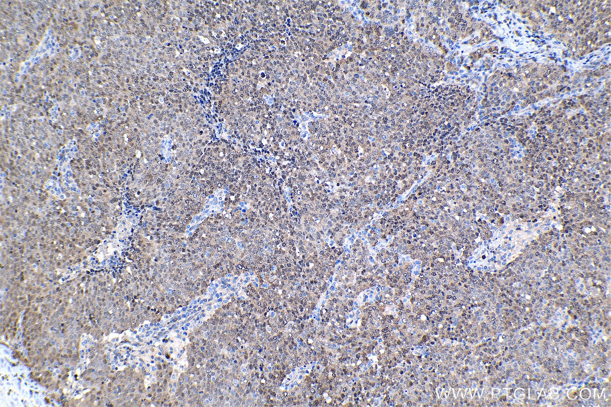 Immunohistochemical analysis of paraffin-embedded human ovary tumor tissue slide using KHC1308 (PSMB5 IHC Kit).