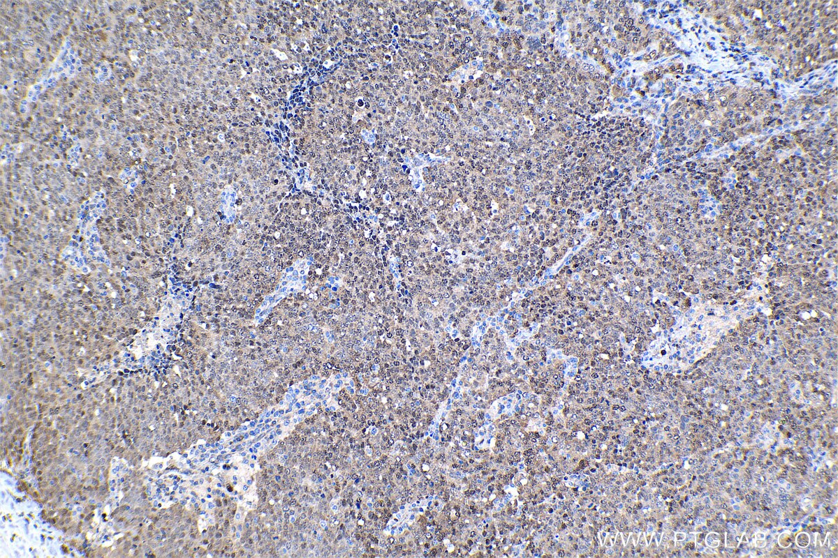 Immunohistochemical analysis of paraffin-embedded human ovary tumor tissue slide using KHC1308 (PSMB5 IHC Kit).