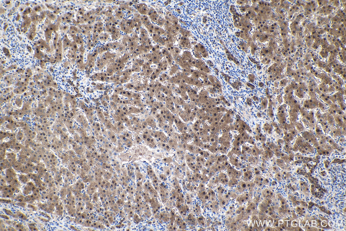 Immunohistochemical analysis of paraffin-embedded human liver cancer tissue slide using KHC1573 (PSMB6 IHC Kit).