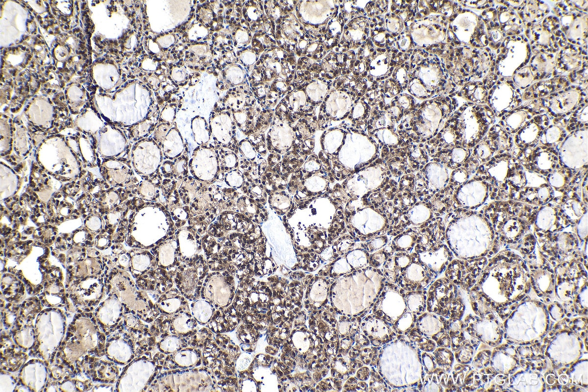 Immunohistochemical analysis of paraffin-embedded human thyroid cancer tissue slide using KHC1573 (PSMB6 IHC Kit).