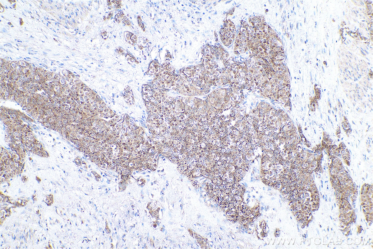 Immunohistochemical analysis of paraffin-embedded human urothelial carcinoma tissue slide using KHC0812 (PSMB7 IHC Kit).