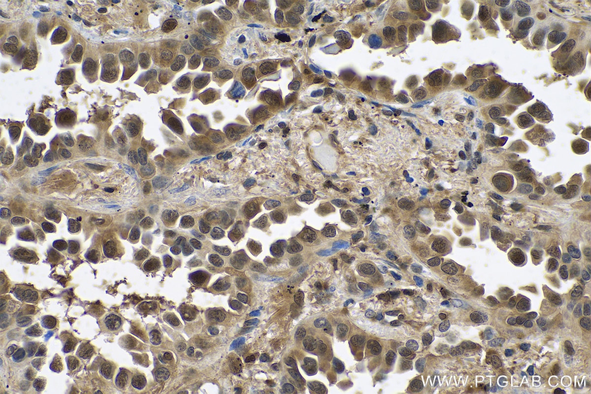 Immunohistochemical analysis of paraffin-embedded human lung cancer tissue slide using KHC0780 (PSMB8 IHC Kit).