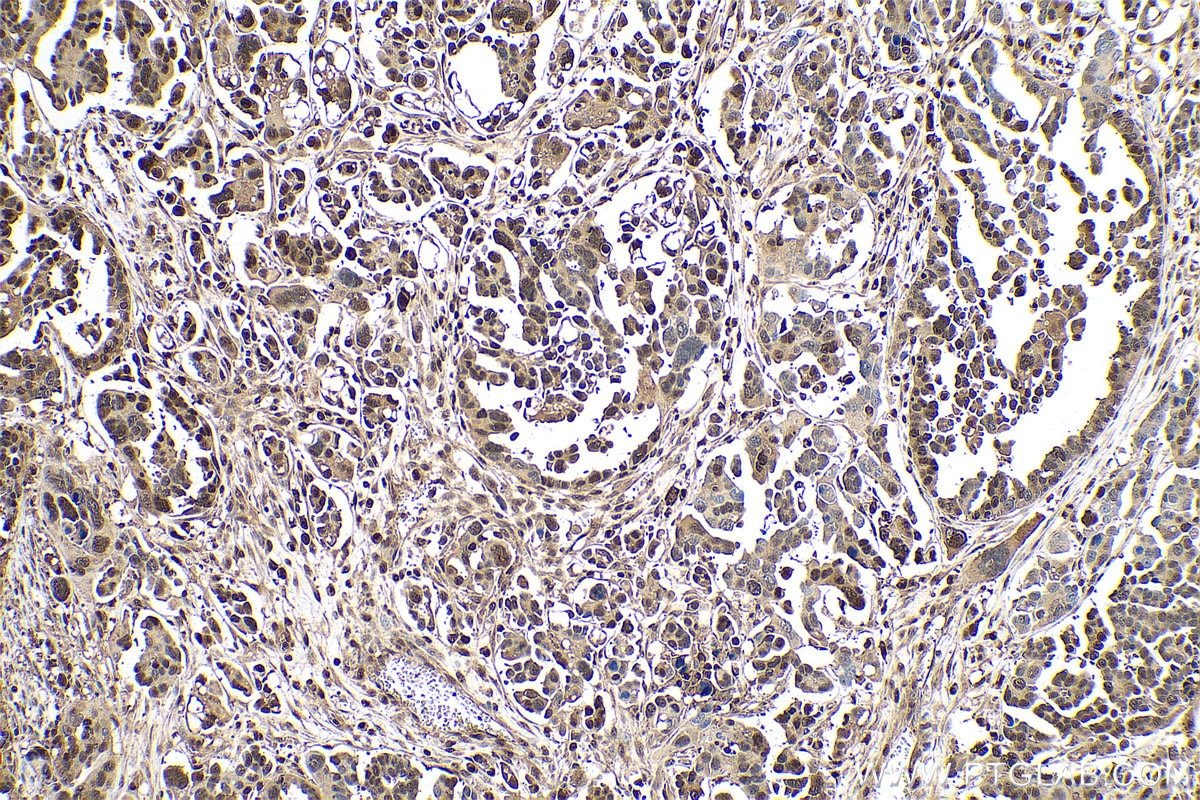 Immunohistochemical analysis of paraffin-embedded human colon cancer tissue slide using KHC0780 (PSMB8 IHC Kit).