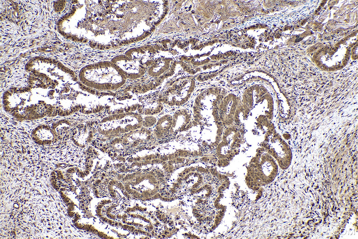 Immunohistochemical analysis of paraffin-embedded human ovary tumor tissue slide using KHC0780 (PSMB8 IHC Kit).