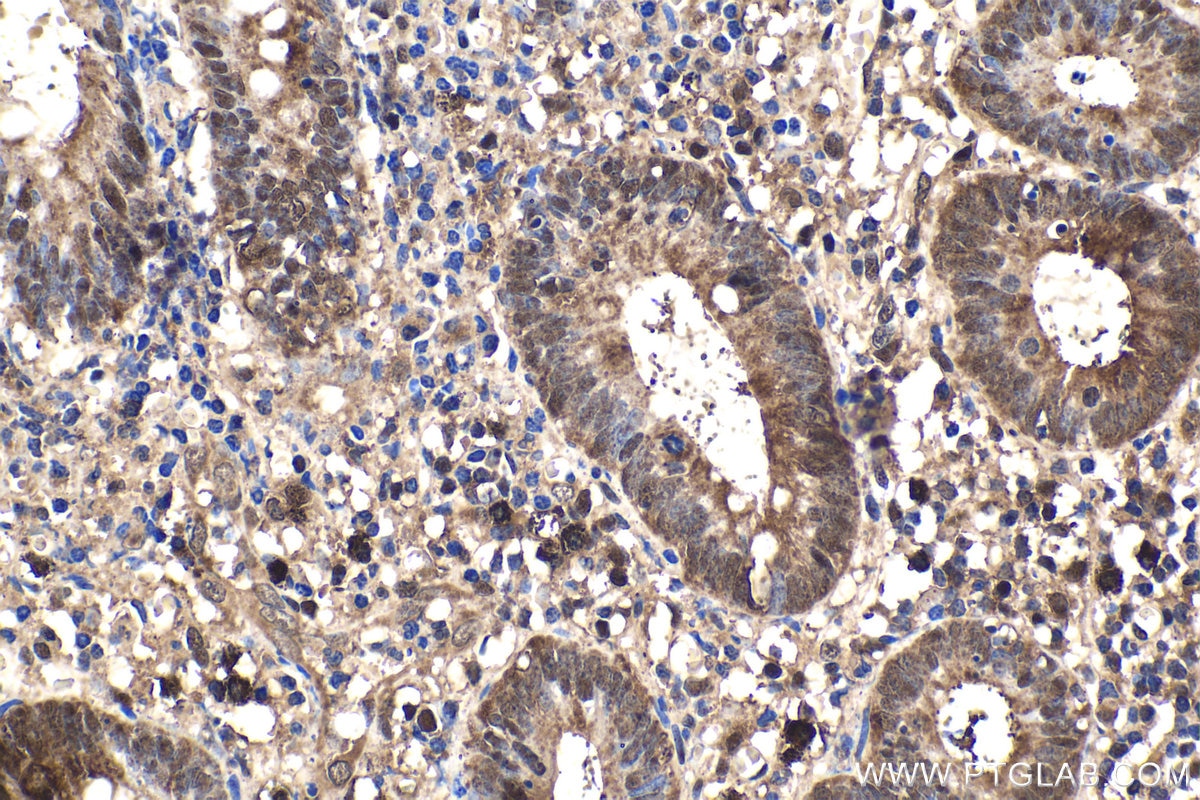 Immunohistochemical analysis of paraffin-embedded human appendicitis tissue slide using KHC1570 (PSMB9 IHC Kit).