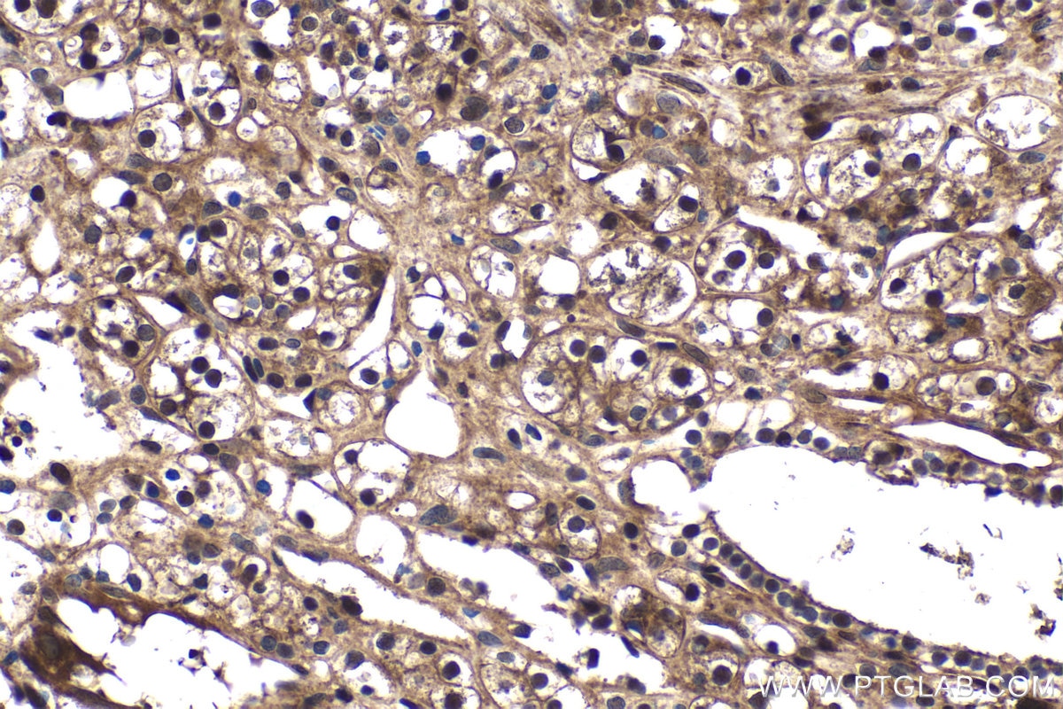 Immunohistochemical analysis of paraffin-embedded human renal cell carcinoma tissue slide using KHC1570 (PSMB9 IHC Kit).