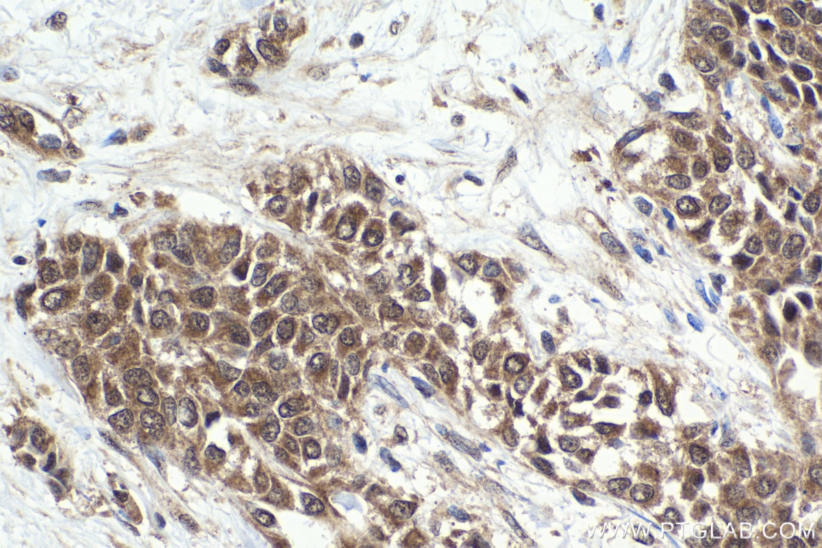 Immunohistochemical analysis of paraffin-embedded human urothelial carcinoma tissue slide using KHC1644 (PSMC1 IHC Kit).