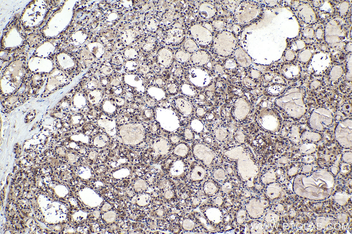 Immunohistochemical analysis of paraffin-embedded human thyroid cancer tissue slide using KHC1644 (PSMC1 IHC Kit).