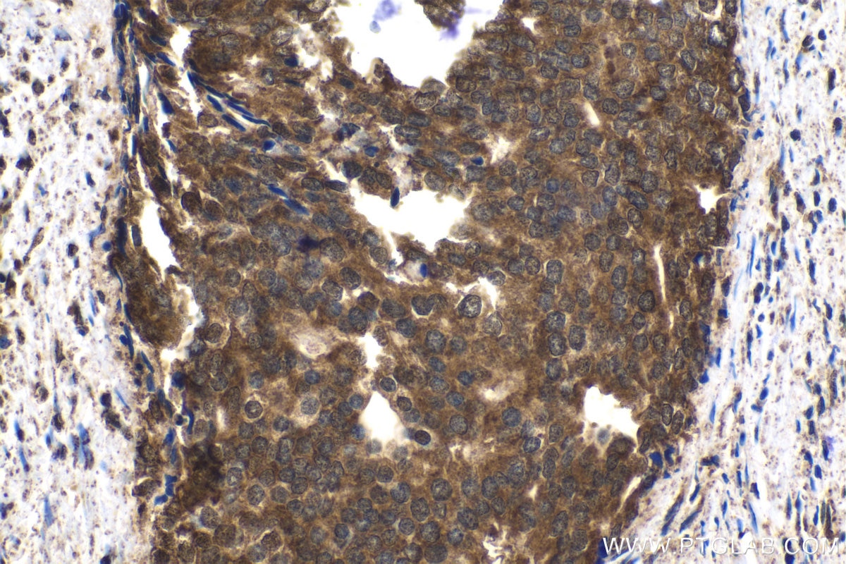 Immunohistochemical analysis of paraffin-embedded human prostate cancer tissue slide using KHC1541 (PSMC3 IHC Kit).