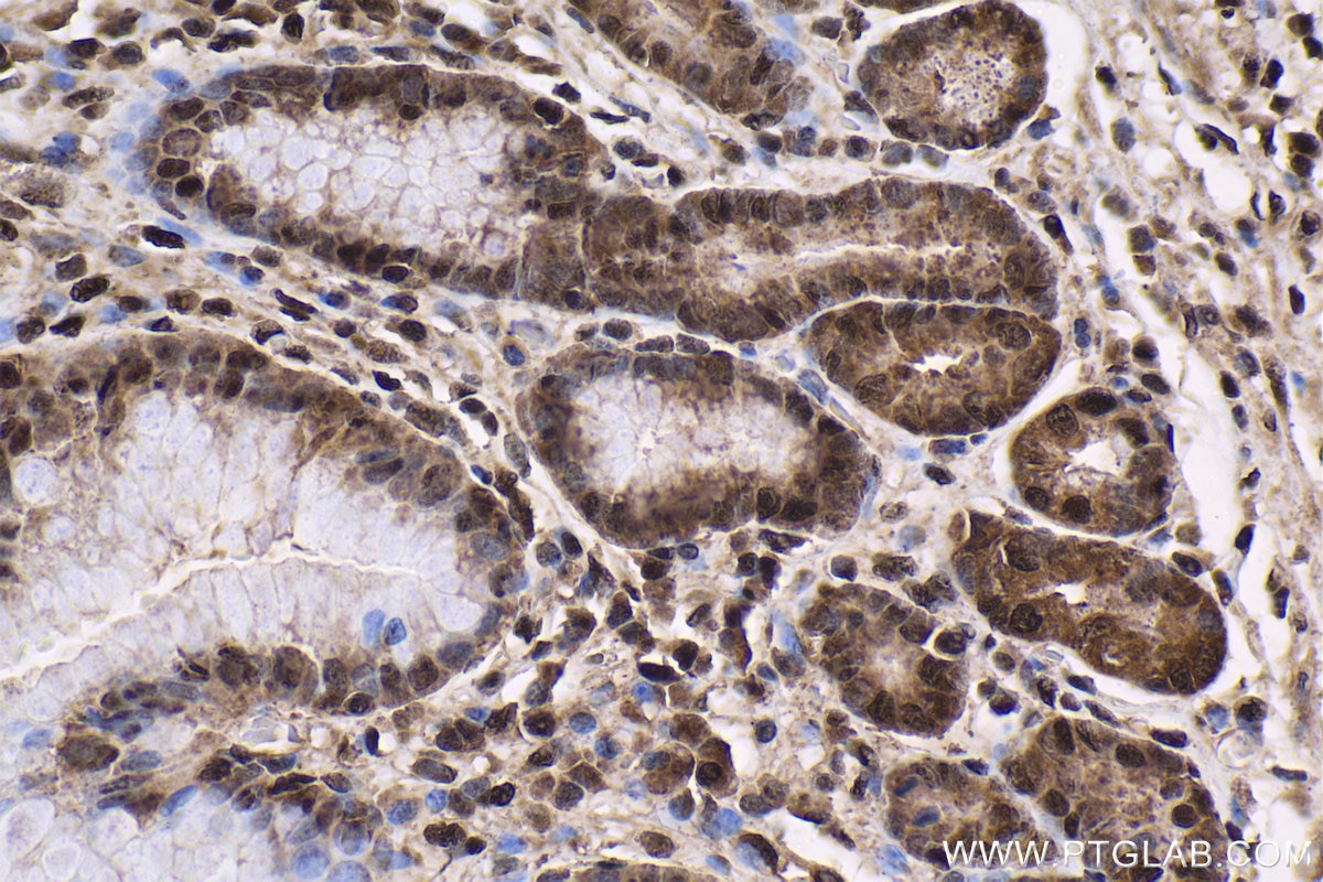 Immunohistochemical analysis of paraffin-embedded human stomach cancer tissue slide using KHC1598 (PSMC4 IHC Kit).