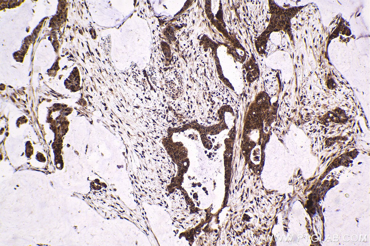 Immunohistochemical analysis of paraffin-embedded human urothelial carcinoma tissue slide using KHC1598 (PSMC4 IHC Kit).