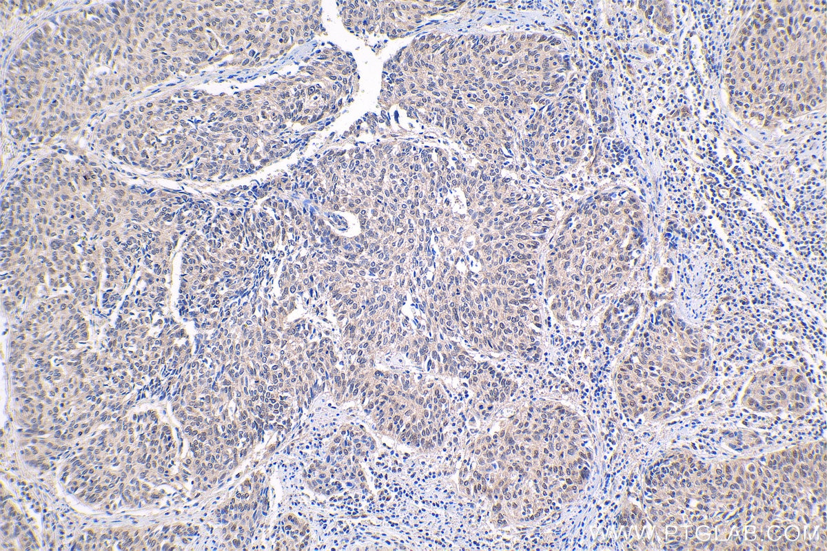 Immunohistochemical analysis of paraffin-embedded human cervical cancer tissue slide using KHC1646 (PSMC6 IHC Kit).