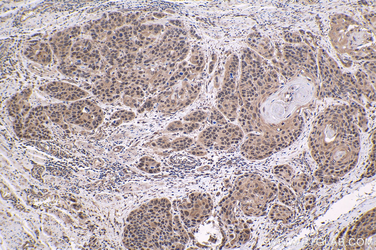 Immunohistochemical analysis of paraffin-embedded human oesophagus cancer tissue slide using KHC1646 (PSMC6 IHC Kit).