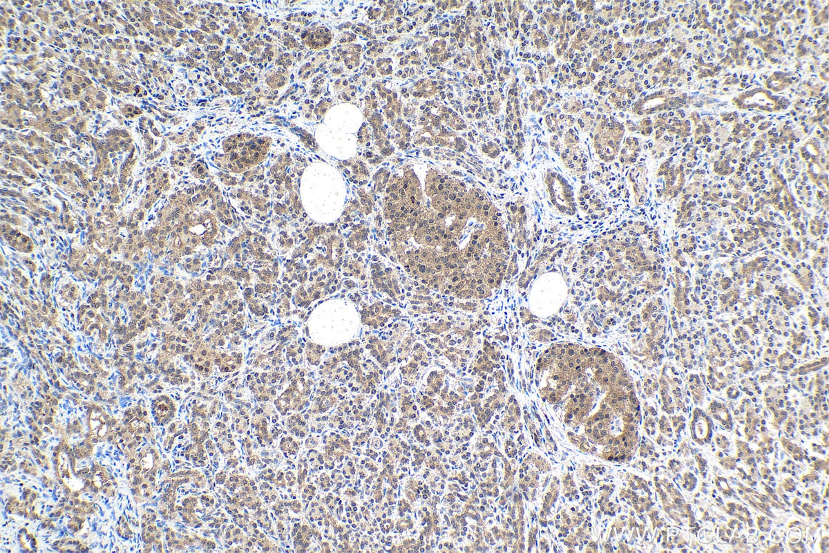 Immunohistochemical analysis of paraffin-embedded human pancreas cancer tissue slide using KHC1477 (PSMD10 IHC Kit).