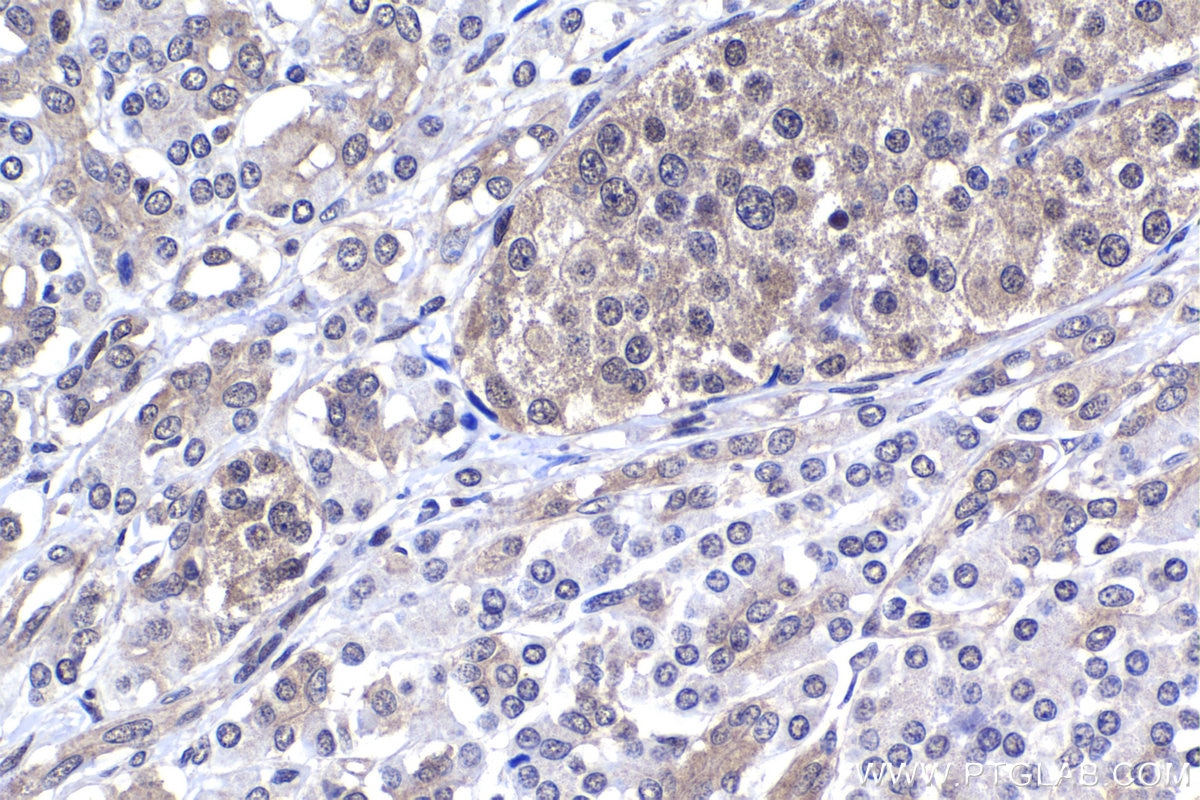 Immunohistochemical analysis of paraffin-embedded human pancreas cancer tissue slide using KHC1419 (PSMD11 IHC Kit).