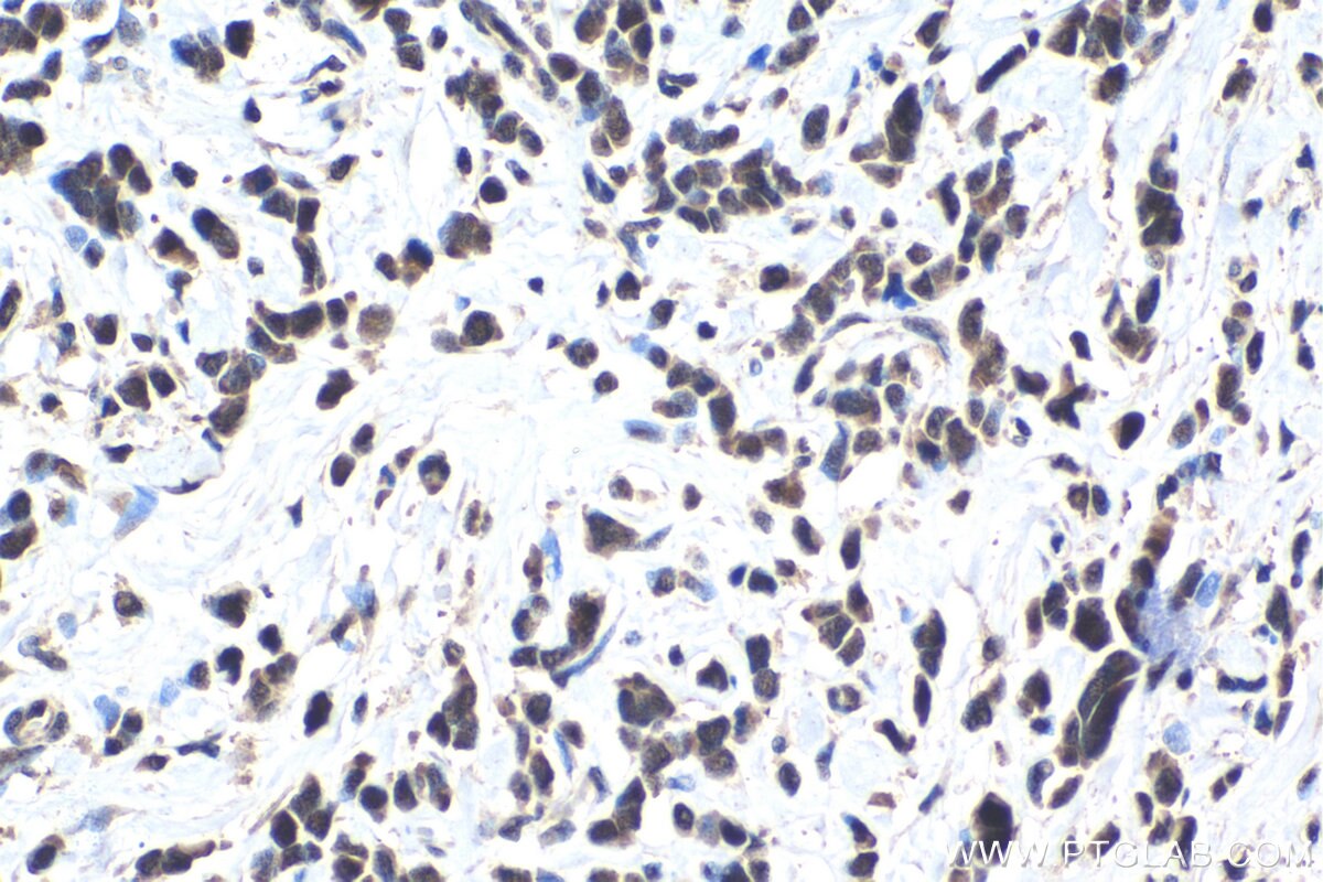 Immunohistochemical analysis of paraffin-embedded human stomach cancer tissue slide using KHC1419 (PSMD11 IHC Kit).