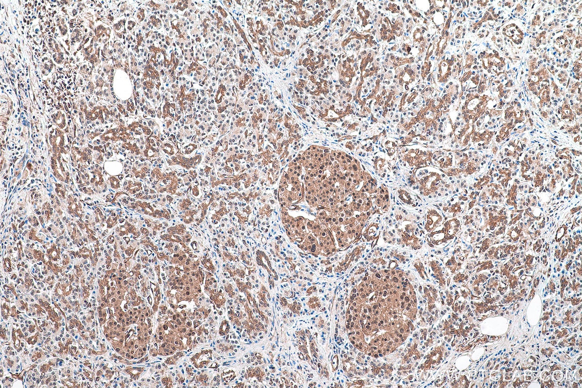 Immunohistochemical analysis of paraffin-embedded human pancreas cancer tissue slide using KHC0895 (PSMD13 IHC Kit).