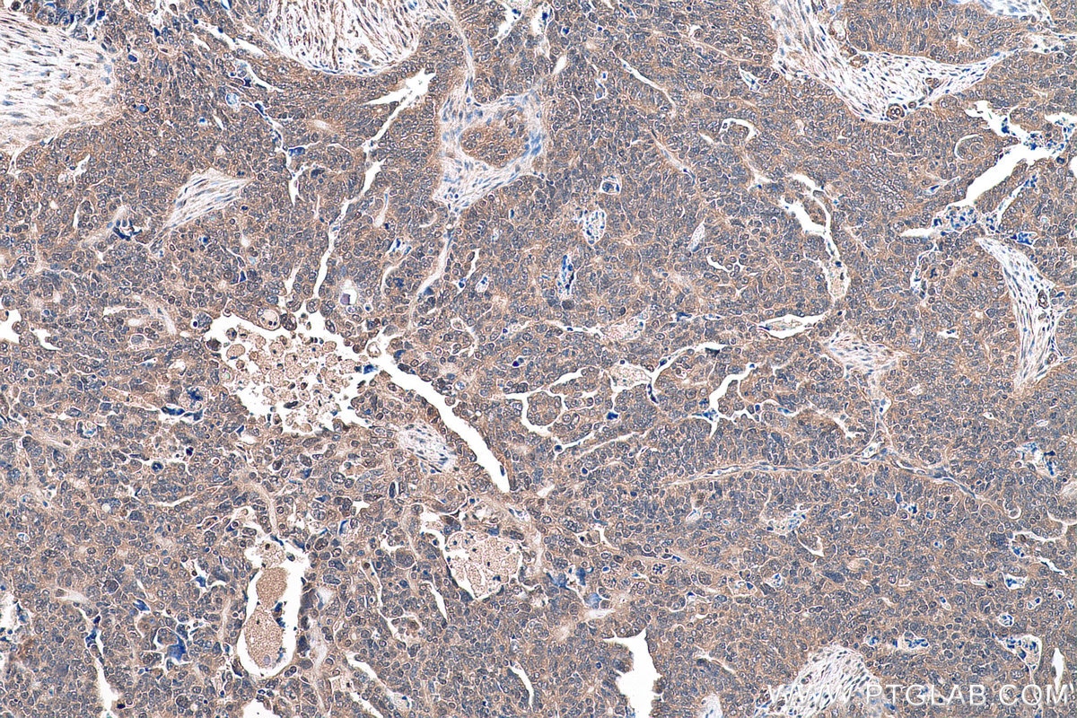 Immunohistochemical analysis of paraffin-embedded human ovary tumor tissue slide using KHC0895 (PSMD13 IHC Kit).