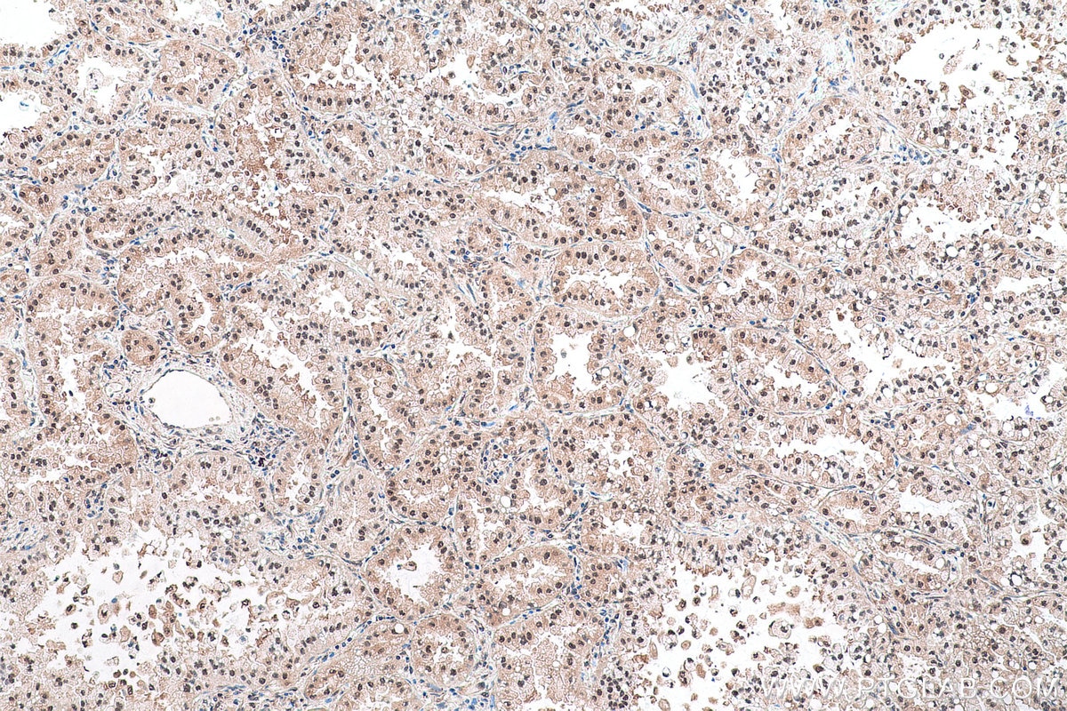 Immunohistochemical analysis of paraffin-embedded human lung cancer tissue slide using KHC0895 (PSMD13 IHC Kit).