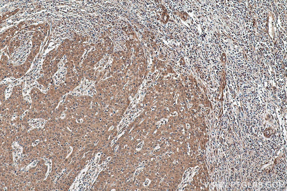 Immunohistochemical analysis of paraffin-embedded human cervical cancer tissue slide using KHC0895 (PSMD13 IHC Kit).