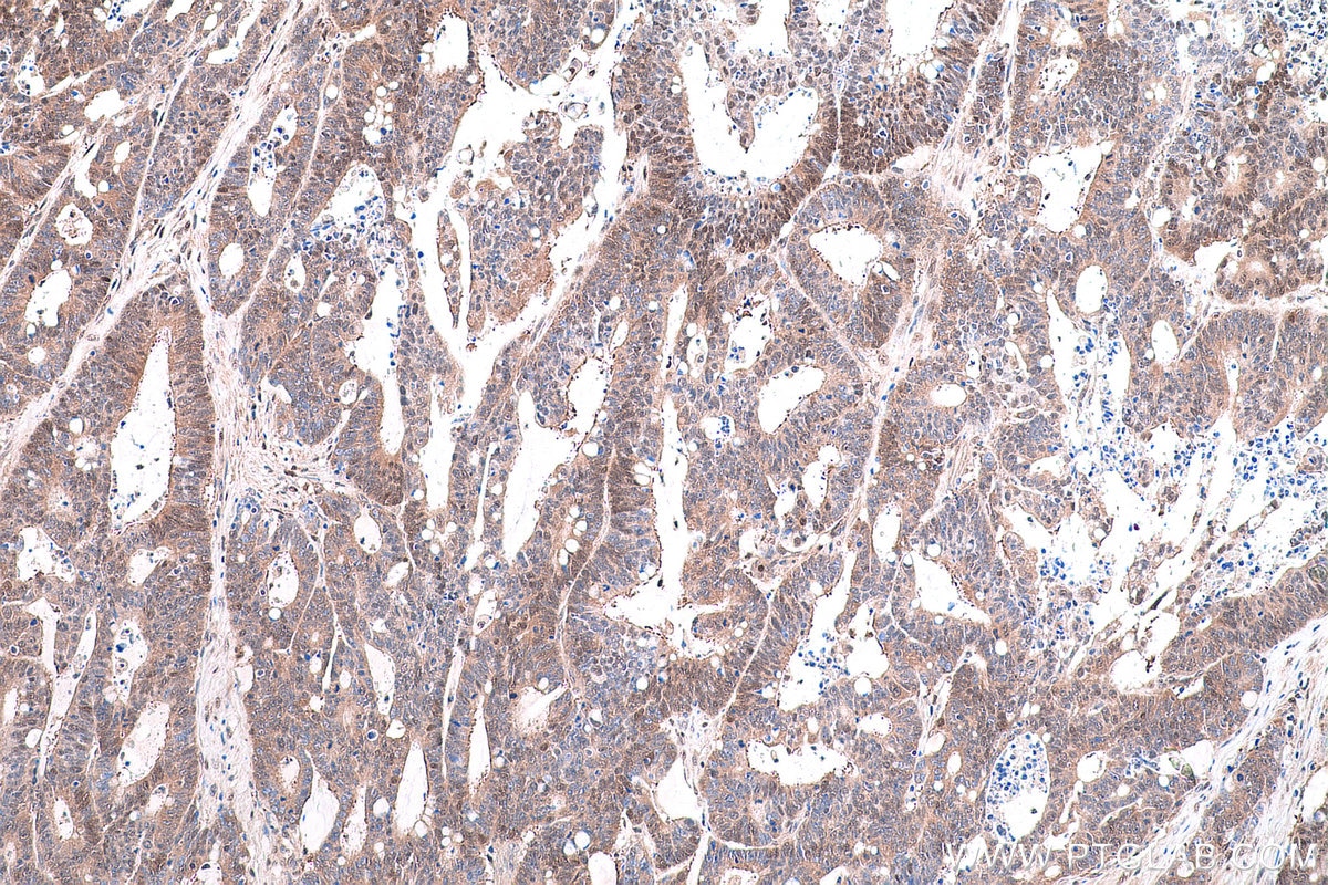 Immunohistochemical analysis of paraffin-embedded human colon cancer tissue slide using KHC0858 (PSMD5 IHC Kit).