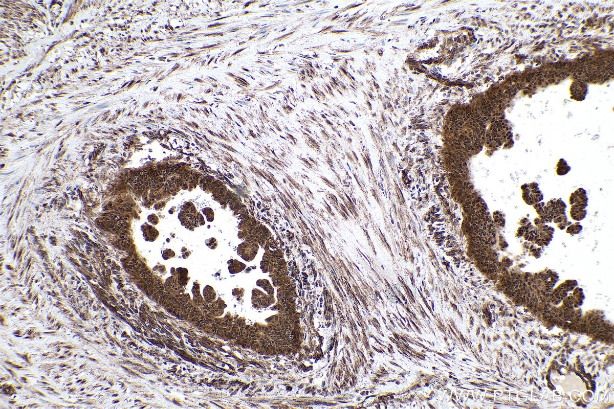 Immunohistochemical analysis of paraffin-embedded human urothelial carcinoma tissue slide using KHC0858 (PSMD5 IHC Kit).