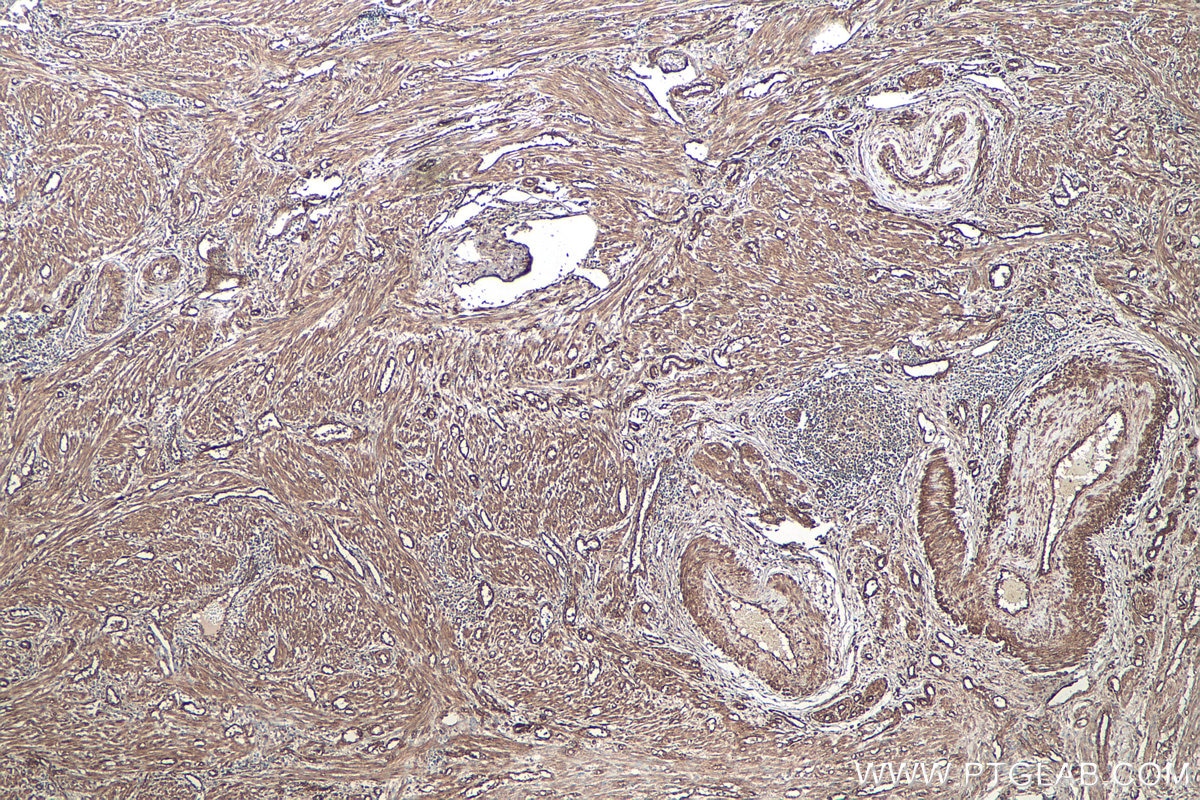 Immunohistochemical analysis of paraffin-embedded human endometrial cancer tissue slide using KHC0858 (PSMD5 IHC Kit).