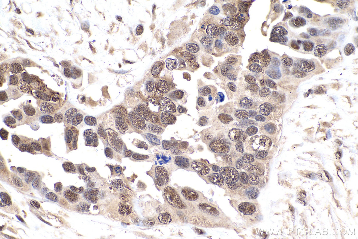 Immunohistochemical analysis of paraffin-embedded human colon cancer tissue slide using KHC0943 (PSMD7 IHC Kit).