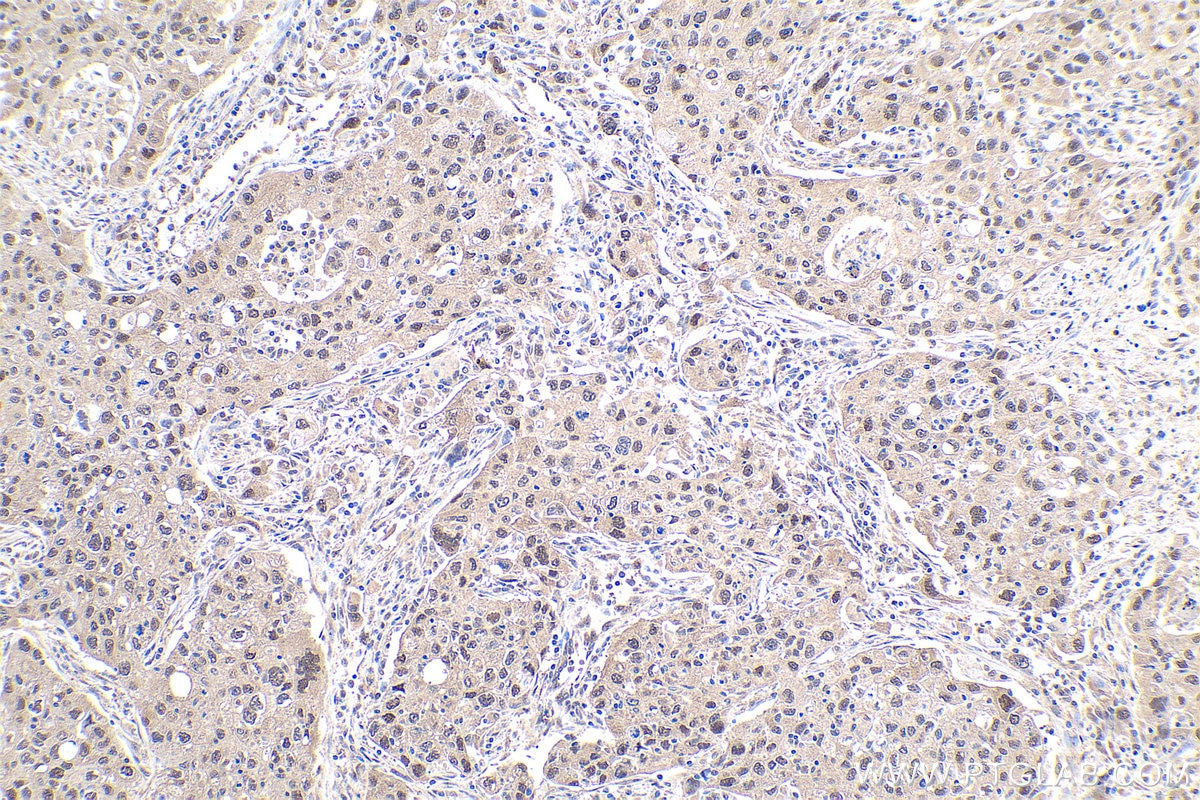 Immunohistochemical analysis of paraffin-embedded human lung cancer tissue slide using KHC0943 (PSMD7 IHC Kit).