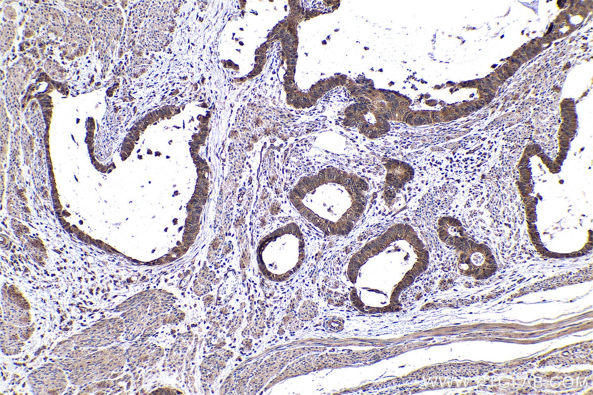 Immunohistochemical analysis of paraffin-embedded human urothelial carcinoma tissue slide using KHC0943 (PSMD7 IHC Kit).