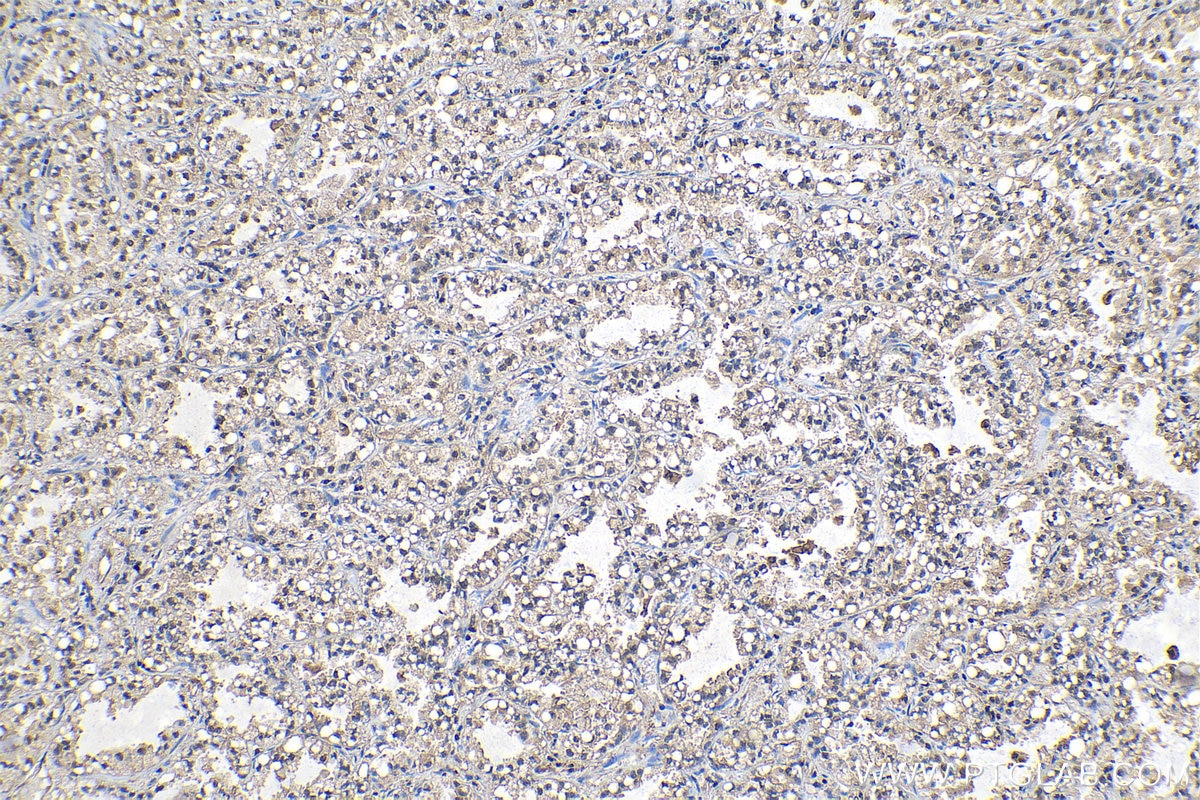 Immunohistochemical analysis of paraffin-embedded human lung cancer tissue slide using KHC1142 (PSME1 IHC Kit).