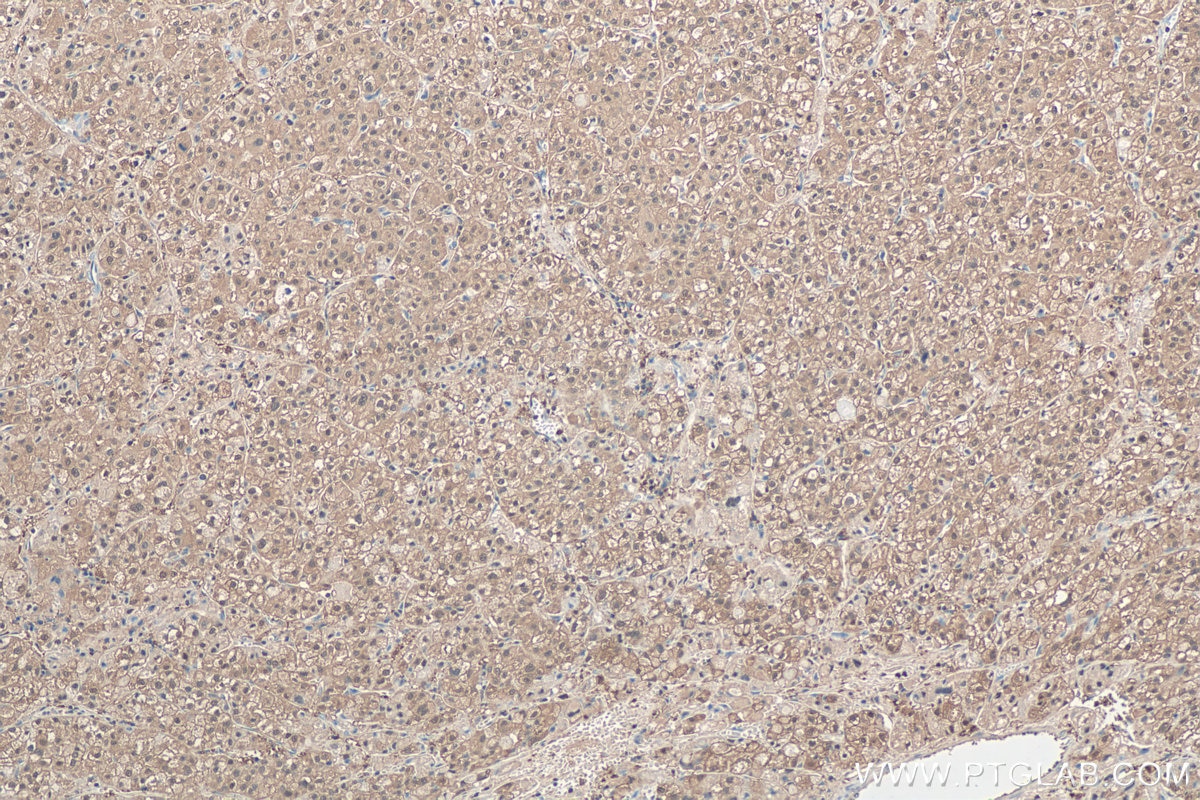 Immunohistochemical analysis of paraffin-embedded human liver cancer tissue slide using KHC0449 (PSME2 IHC Kit).